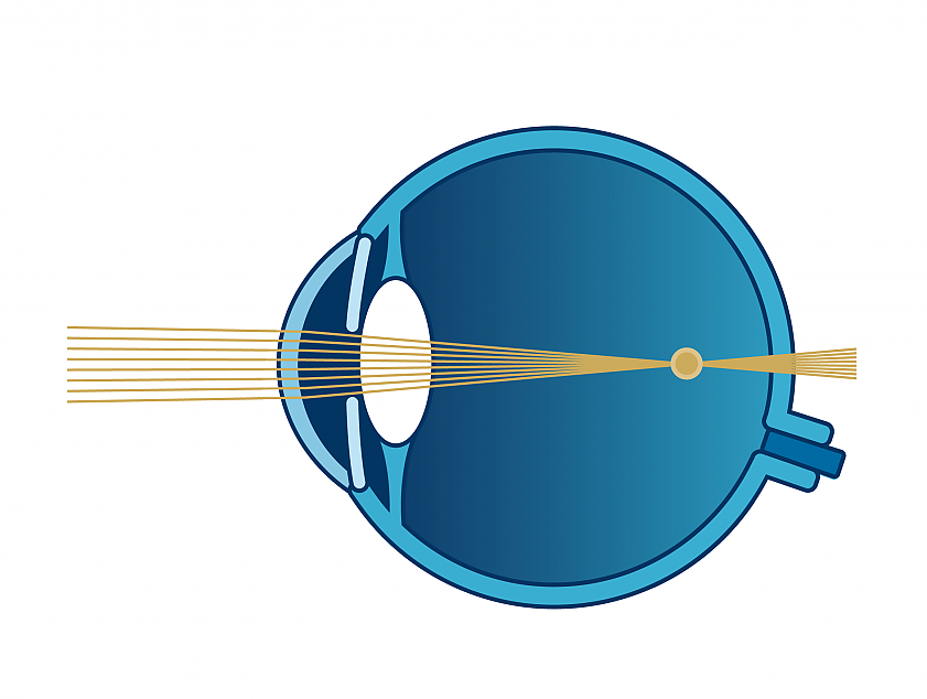 Schema Sehfehler Kurzsichtigkeit | VisuLASE Augenlaserzentrum Weilheim