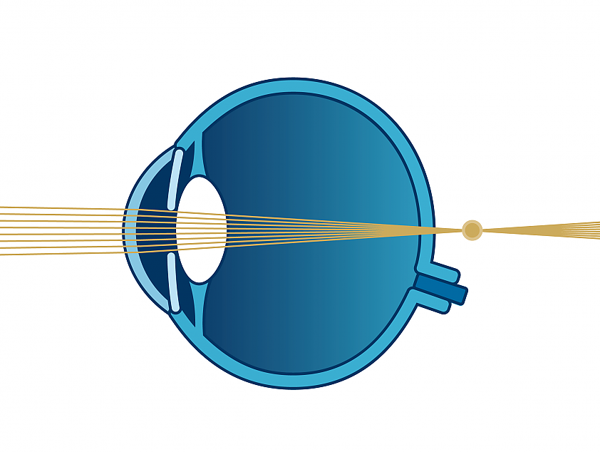 Schema Sehfehler Weitsichtigkeit | VisuLASE Augenlaserzentrum Weilheim