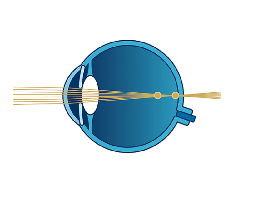 Schema Sehfehler Hornhautverkrümmung| VisuLASE Augenlaserzentrum Weilheim